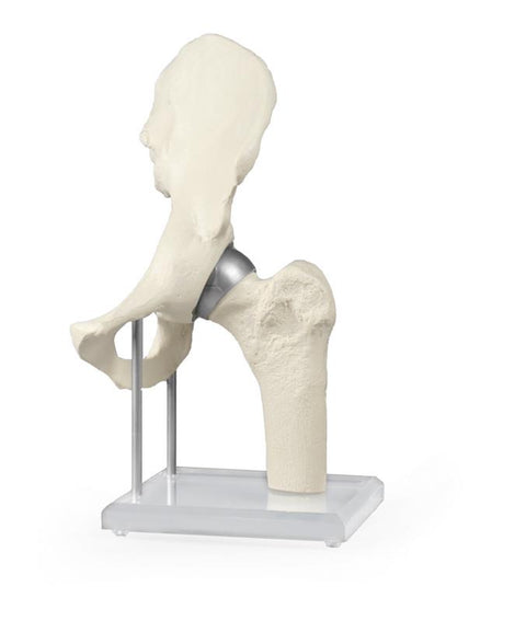 Articulația șoldului cu implant de resurfațare