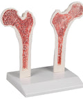 Femur cu osteoporoză
