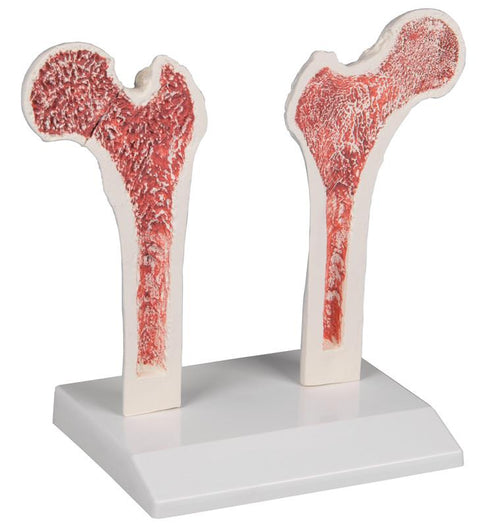 Femur cu osteoporoză