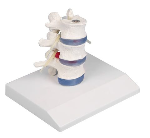 Vertebre lombare cu discuri intervertebrale prolabate cu suport