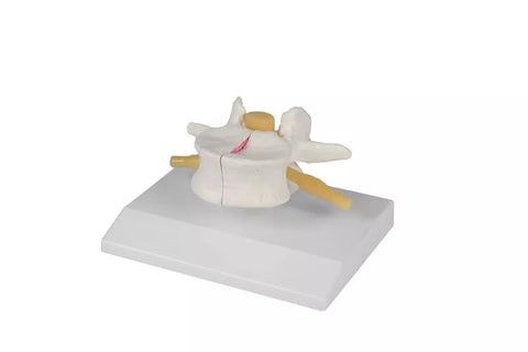 Vertebră cu osteoporoză, mărite de 2 ori mărime naturală