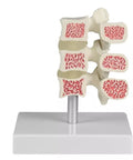 Model de osteoporoză vertebrală, 3 vertebre