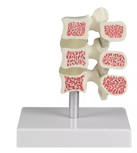 Model de osteoporoză vertebrală, 3 vertebre