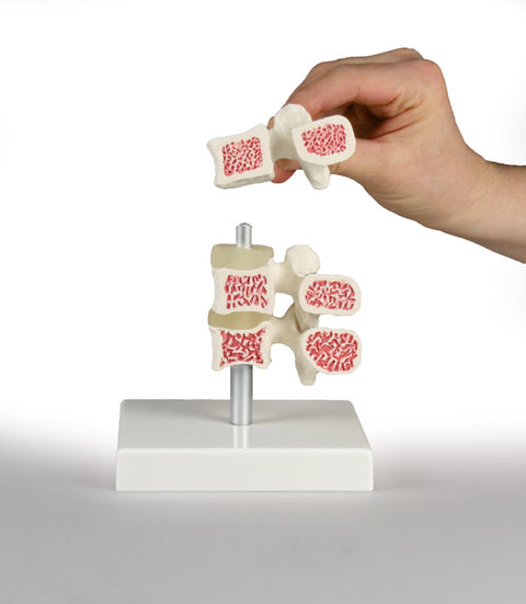Model de osteoporoză vertebrală, 3 vertebre