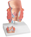 Model hemoroizi