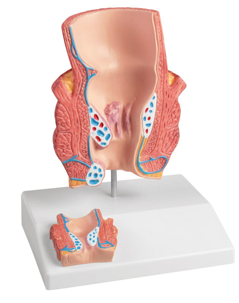 Model hemoroizi
