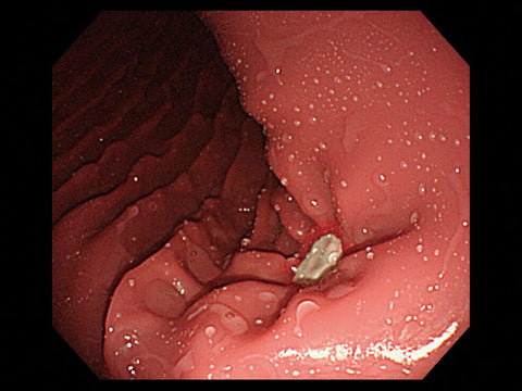 Simulator EGD (esofagogastroduodenoscopie)