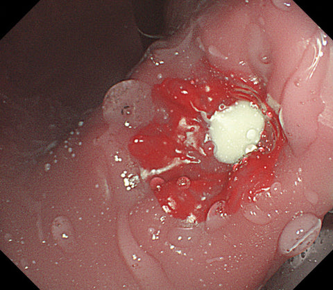 Simulator EGD (esofagogastroduodenoscopie)