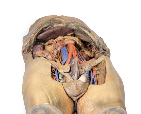 Abdomen cu hernii bilaterale