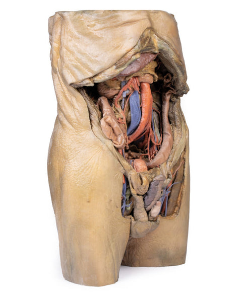 Abdomen cu hernii bilaterale