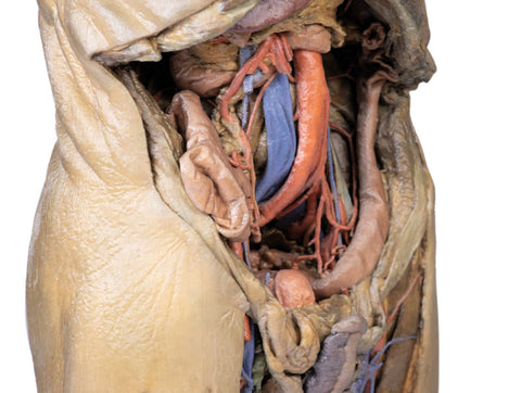 Abdomen cu hernii bilaterale