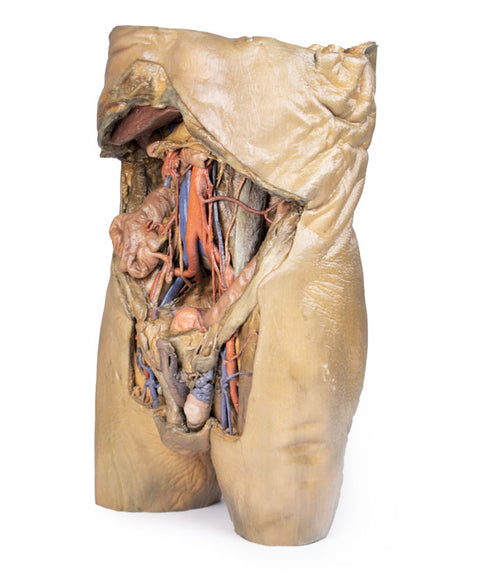 Abdomen cu hernii bilaterale