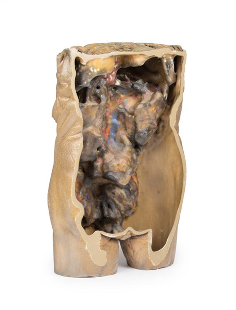 Abdomen cu hernii bilaterale