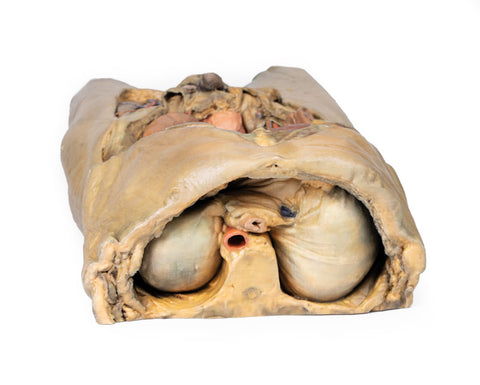 Abdomen cu hernii bilaterale