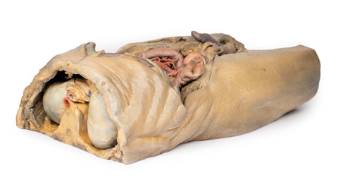 Abdomen cu hernii bilaterale