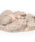 Meningiom