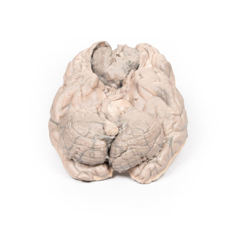 Meningiom