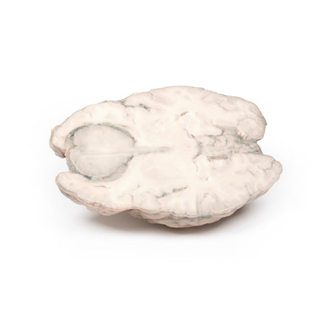 Meningiom