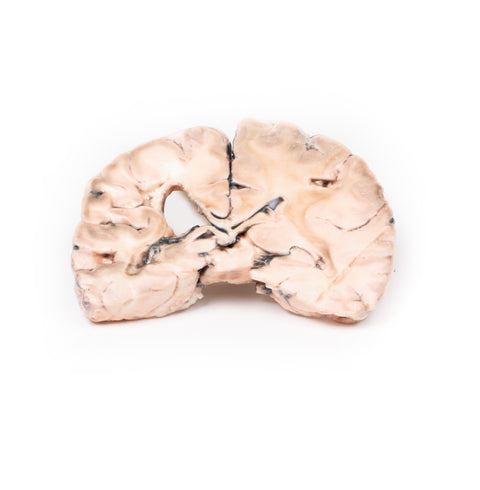 Infarct cerebral stâng