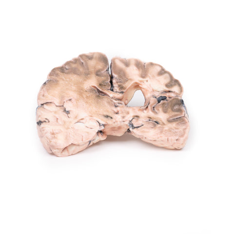 Infarct cerebral stâng