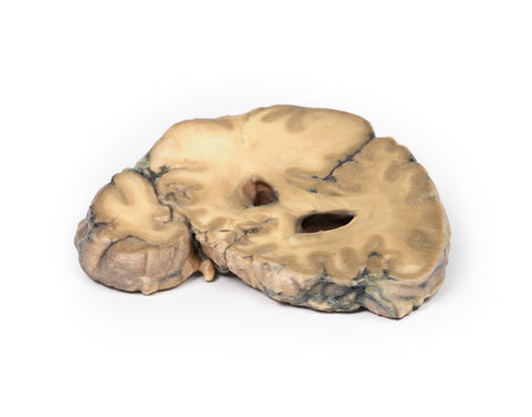 Adenocarcinom metastatic la nivelul creierului