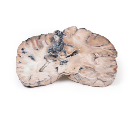 Malformație arterio-venoasă cerebrală