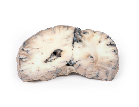 Malformație arterio-venoasă cerebrală