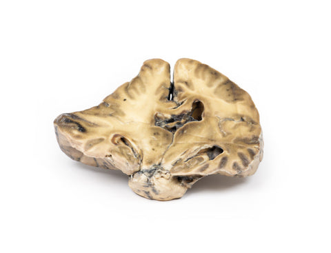 Leziune intracraniană înlocuitoare de spațiu