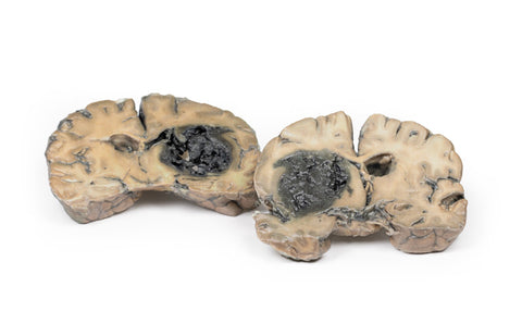 Hemoragie intracerebrală