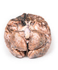 Anevrism sacular rupt