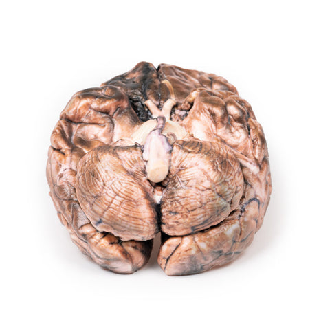 Anevrism sacular rupt