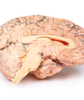 Craniofaringiom