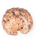 Melanom metastatic