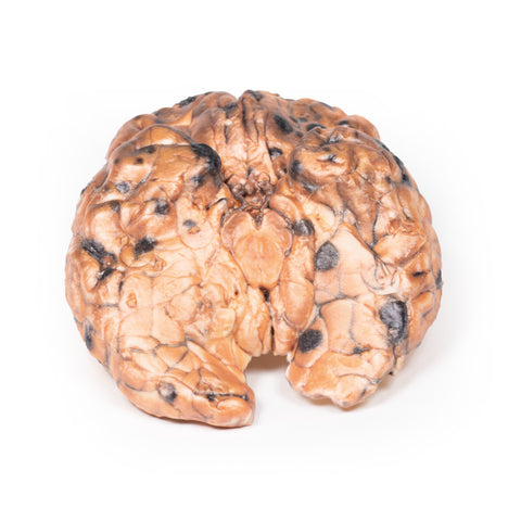 Melanom metastatic