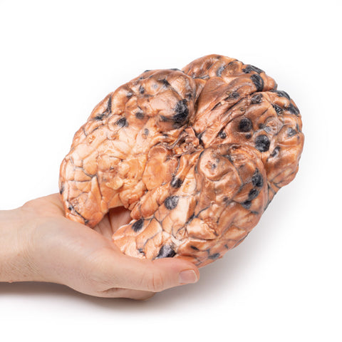 Melanom metastatic