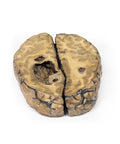 Carcinom metastatic la nivel cerebral