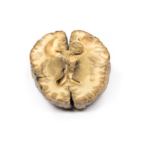 Carcinom metastatic la nivel cerebral