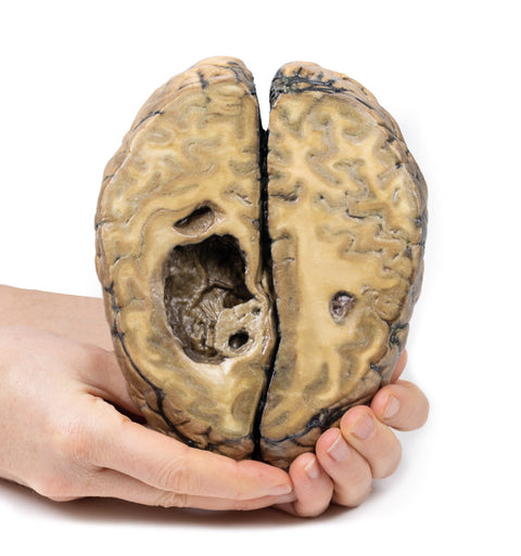 Carcinom metastatic la nivel cerebral