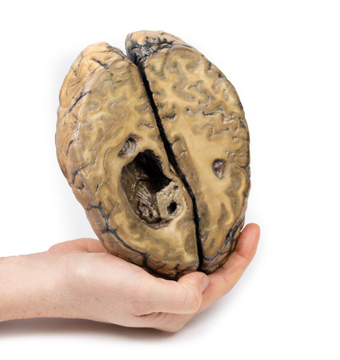 Carcinom metastatic la nivel cerebral