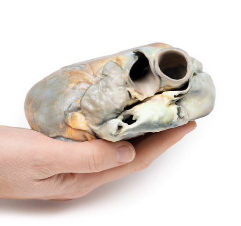 Hipertrofie ventriculară dreaptă