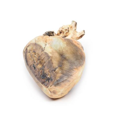 Defect septal atrial