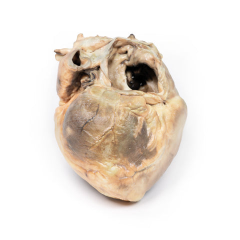 Defect septal atrial