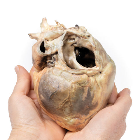 Defect septal atrial