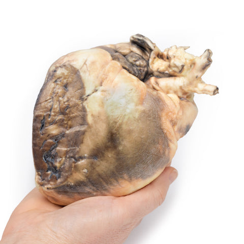 Defect septal atrial