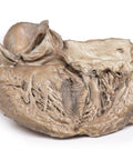 Valvă aortică bicuspidă