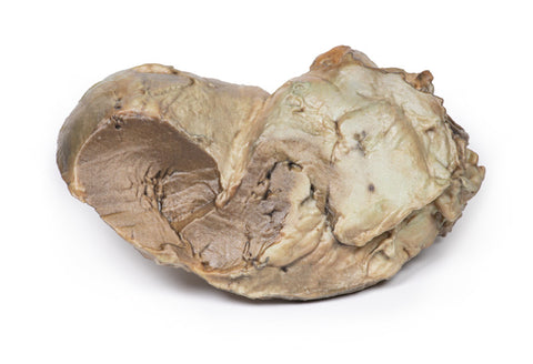 Valvă aortică bicuspidă