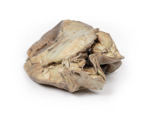 Valvă aortică bicuspidă