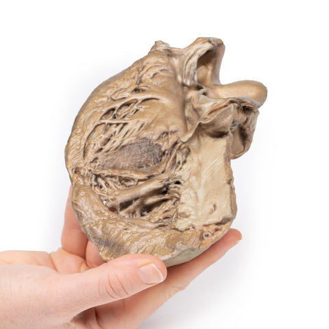 Valvă aortică bicuspidă
