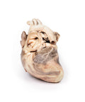Stenoză pulmonară congenitală