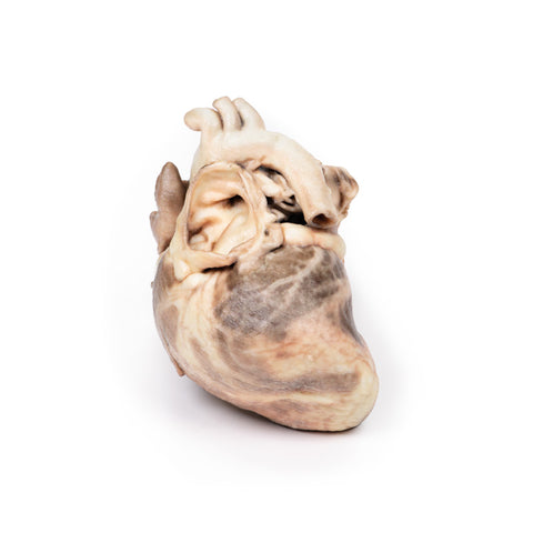 Stenoză pulmonară congenitală